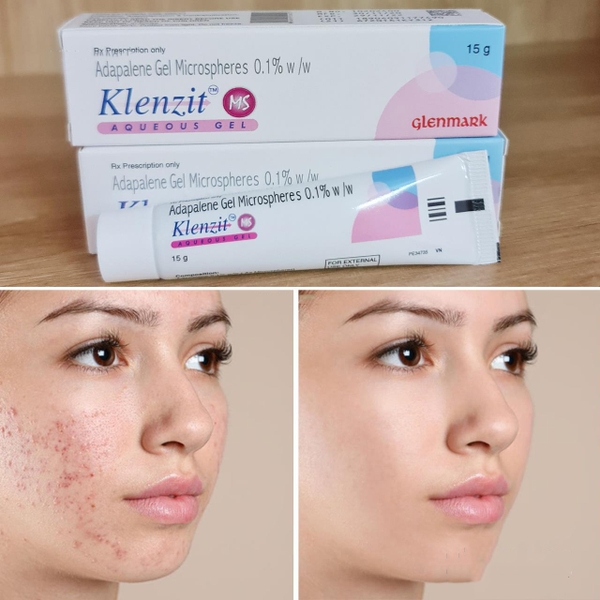 Kem Trị Mụn Klenzit MS 5 kem tri mun klenzit ms 2470 4