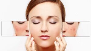 cach tri di ung my pham tai nha nhanh nhat